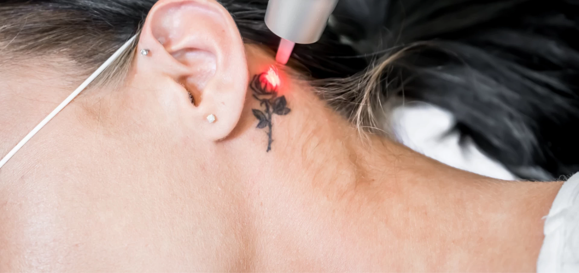 Evaluation of the Efficacy of Tattoo-Removal Treatments with Q-Switch Laser