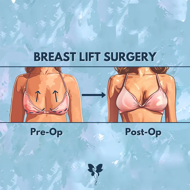 breast lift