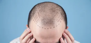 FUE Hair Transplant