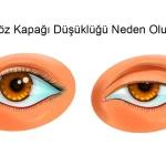 Göz Kapağı Düşüklüğü Neden Olur?