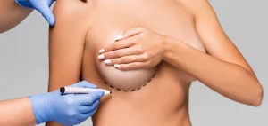 جراحة تصغير الثدي