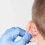 Kulak Estetiği Kaç Yaşında Yapılır?