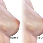 Meme Ucu Ameliyatı Emzirmeyi Etkiler mi?