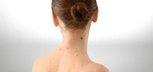 Traitement des Grains de Beauté