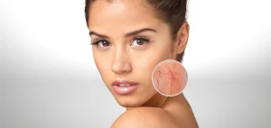 Traitement des Vaisseaux Sanguins au Laser